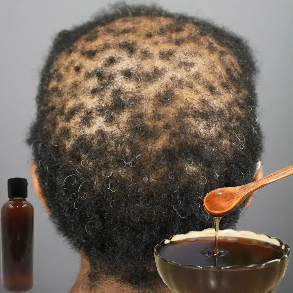 Africa Women Traction Alopecia - Hair Care Ginseng recensione e prezzo